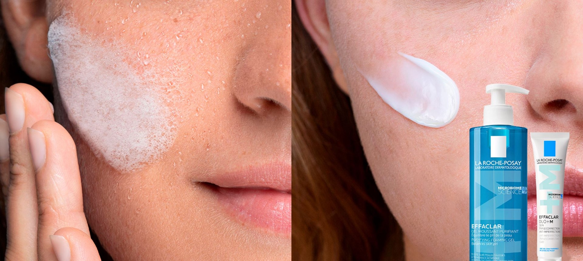 como quitar el acne